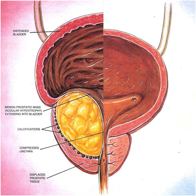 Benign prostatic hypertrophy