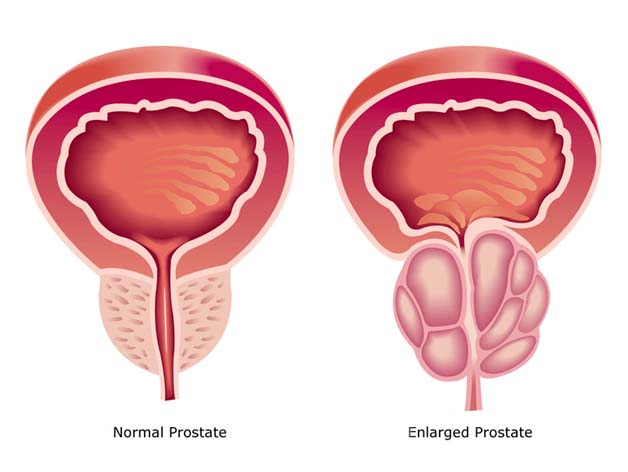 Healthy And Unhealthy Prostate