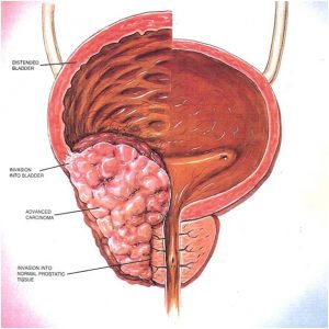 Prostate Cancer