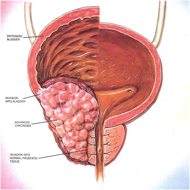 Prostate Cancer