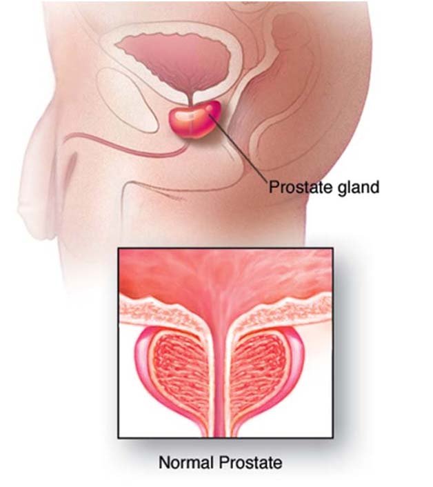 Prevention Tips For Prostate Cancer