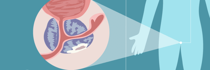 Prostate Cancer