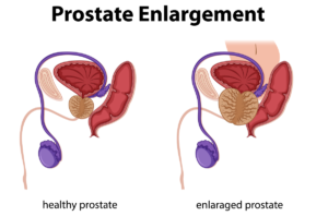 Healthy Prostate