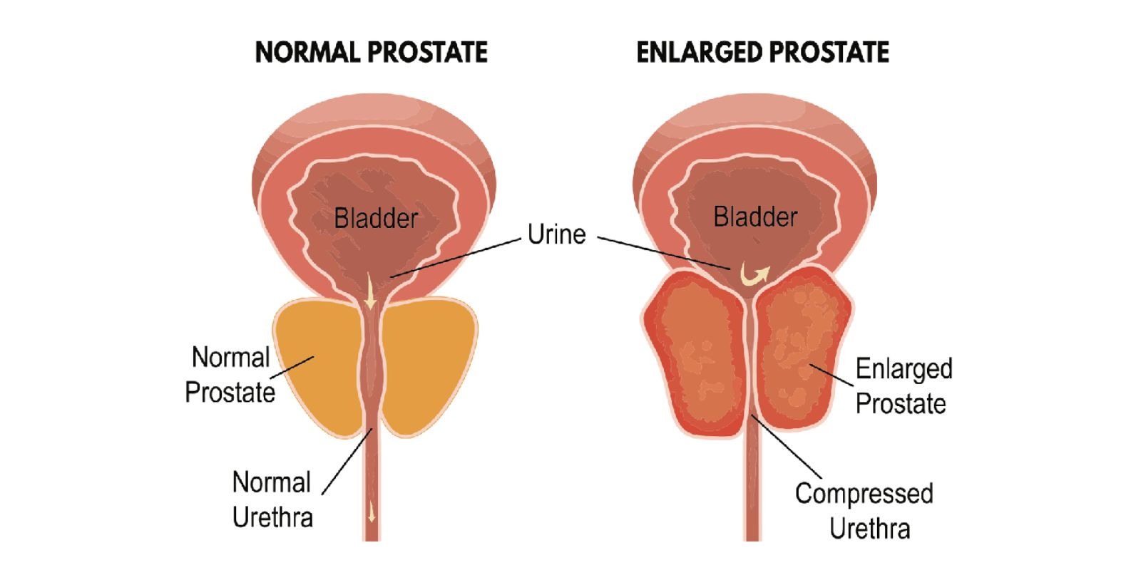 Prostate Health